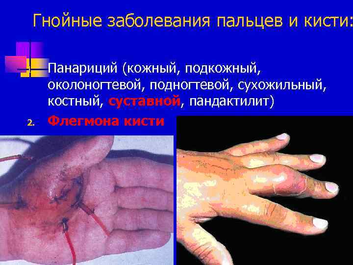 Гнойные заболевания пальцев и кисти: 1. 2. Панариций (кожный, подкожный, околоногтевой, подногтевой, сухожильный, костный,