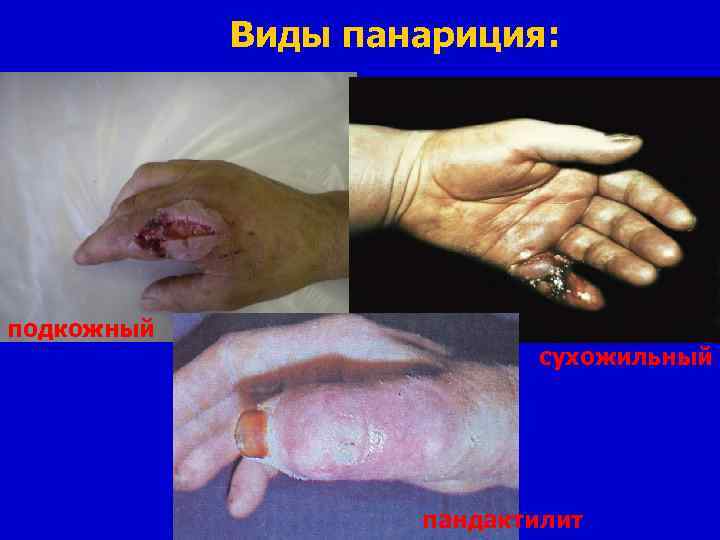 Виды панариция: подкожный сухожильный пандактилит 