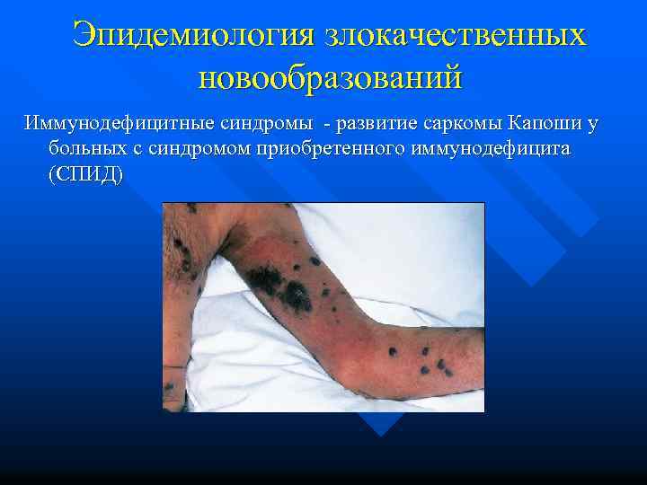 Эпидемиология злокачественных новообразований Иммунодефицитные синдромы - развитие саркомы Капоши у больных с синдромом приобретенного