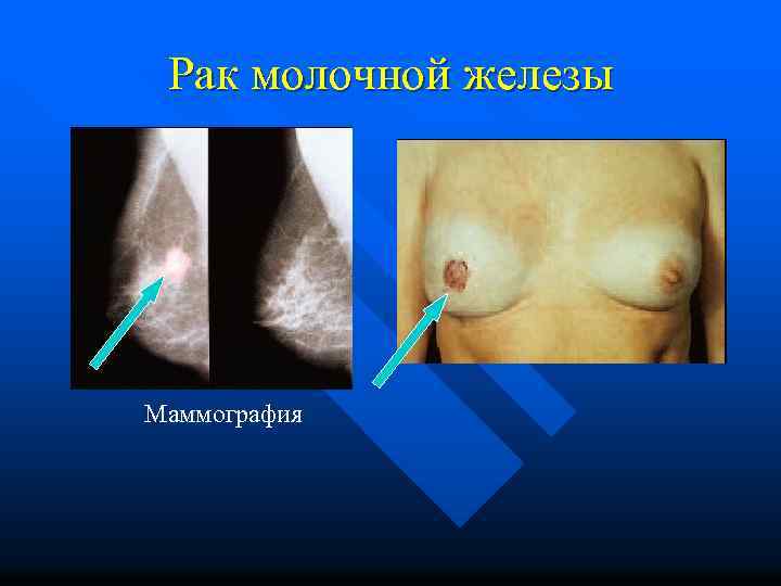 Рак молочной железы Маммография 