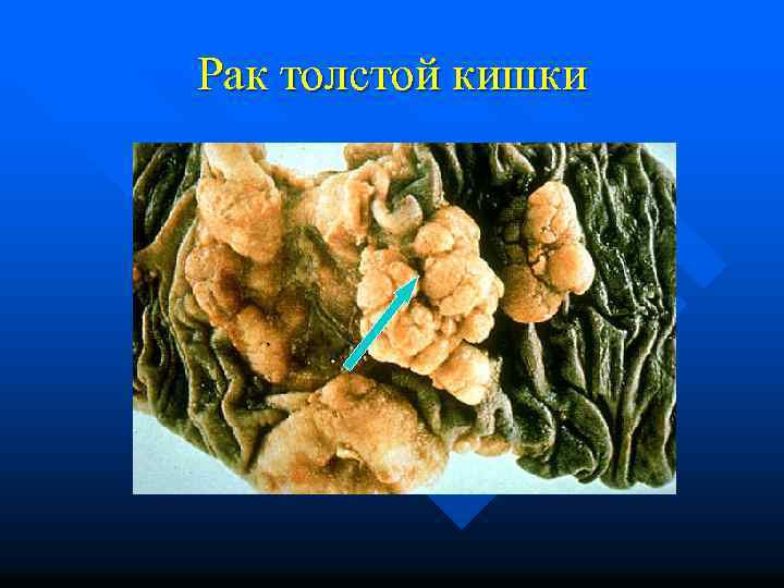 Рак толстой кишки 