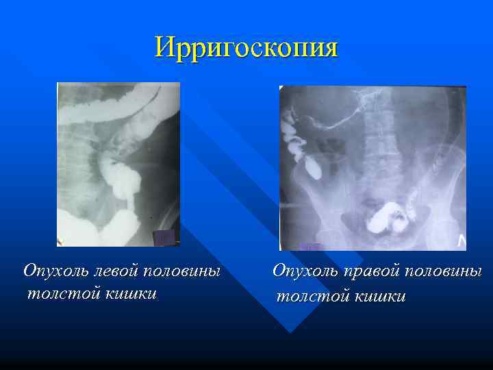 Ирригоскопия подготовка отзывы