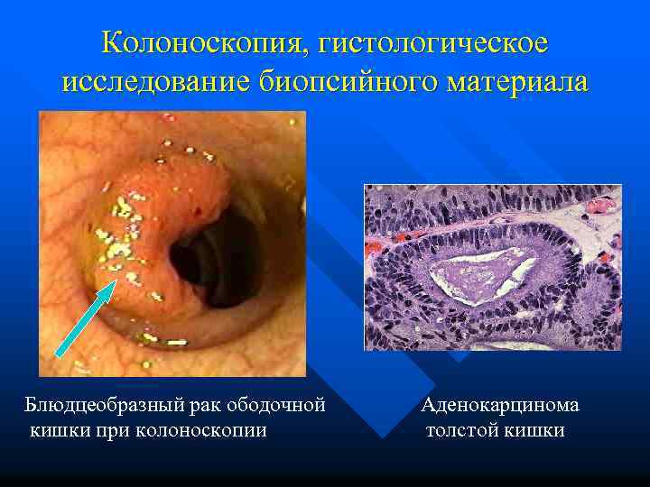 Колоноскопия, гистологическое исследование биопсийного материала Блюдцеобразный рак ободочной кишки при колоноскопии Аденокарцинома толстой кишки