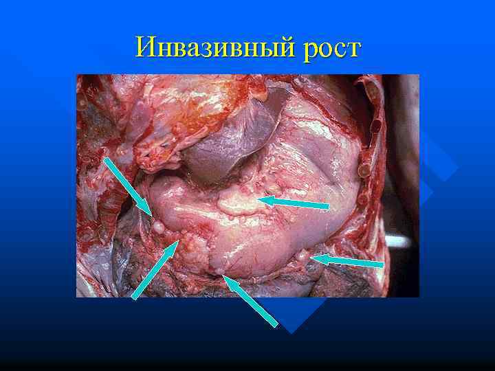 Инвазивный рост 