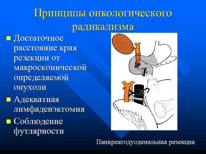 Абластика и антибластика в онкологии. Принципы радикальности. Принцип радикализма в онкологии. Принципы радикальности, абластика, антибластика. Онкологический радикализм это.