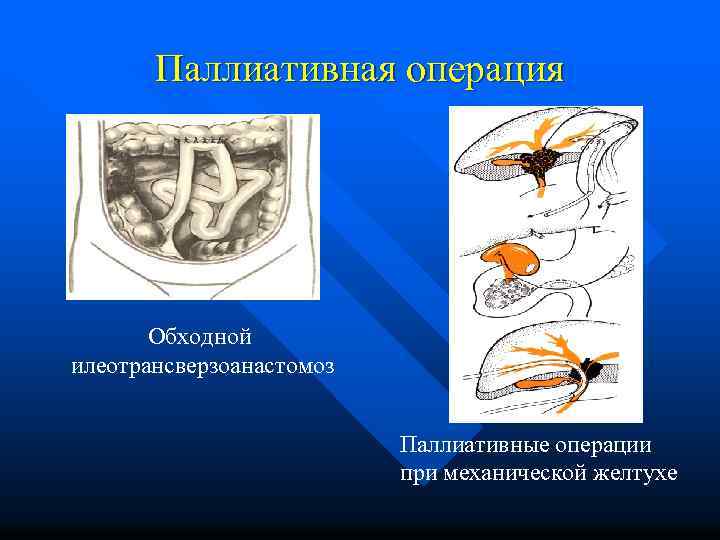 Паллиативная операция Обходной илеотрансверзоанастомоз Паллиативные операции при механической желтухе 