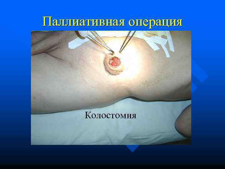 Паллиативная операция Колостомия 