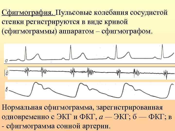 Сфигмография. Пульсовые колебания сосудистой стенки регистрируются в виде кривой (сфигмограммы) аппаратом – сфигмографом. Нормальная