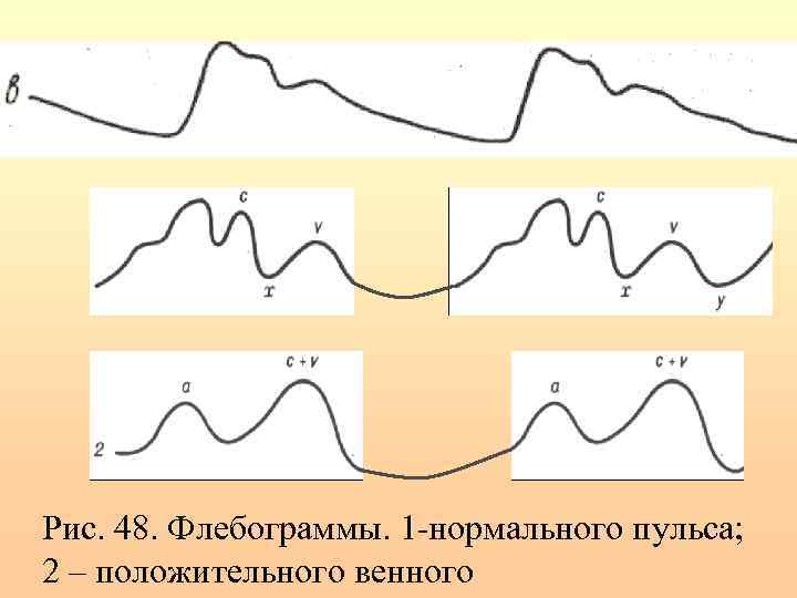 Рис. 48. Флебограммы. 1 -нормального пульса; 2 – положительного венного 