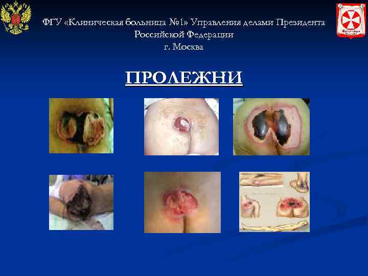 ФГУ «Клиническая больница № 1» Управления делами Президента Российской Федерации г. Москва ПРОЛЕЖНИ 