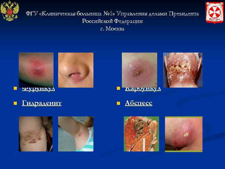ФГУ «Клиническая больница № 1» Управления делами Президента Российской Федерации г. Москва n Фурункул
