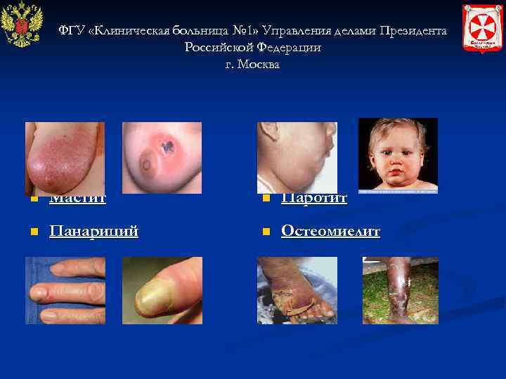 ФГУ «Клиническая больница № 1» Управления делами Президента Российской Федерации г. Москва n Мастит