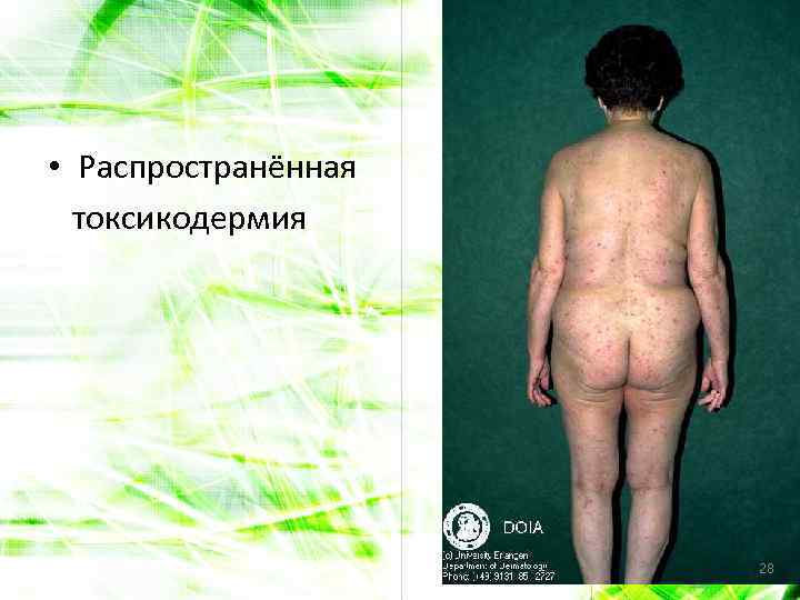  • Распространённая токсикодермия 28 