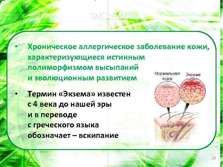 ЭКЗЕМА • Хроническое аллергическое заболевание кожи, характеризующиеся истинным полиморфизмом высыпаний Нормальная Экзема кожа и