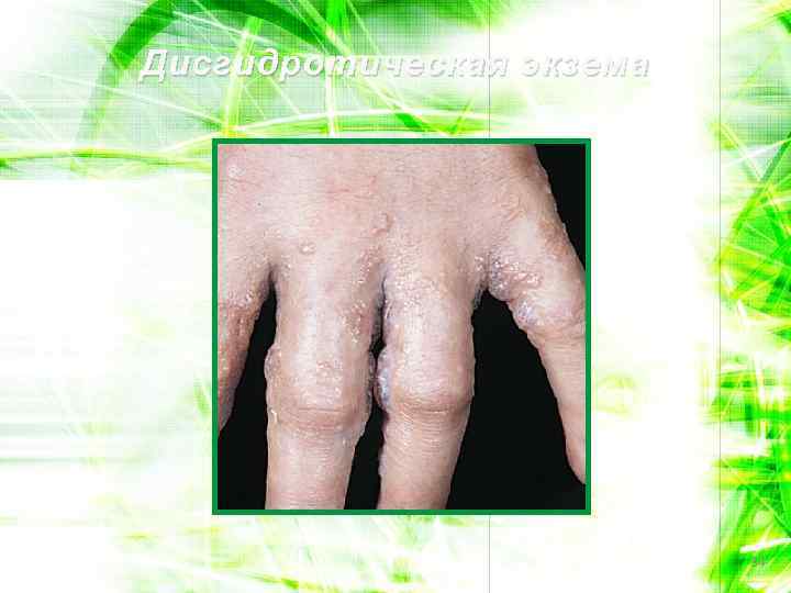 Дисгидротическая экзема 34 