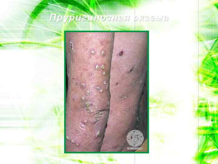 Пруригинозная экзема 35 