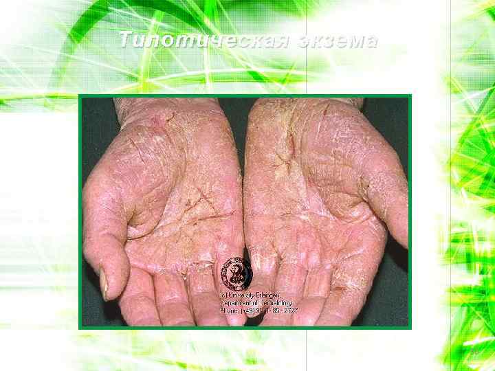 Тилотическая экзема 36 