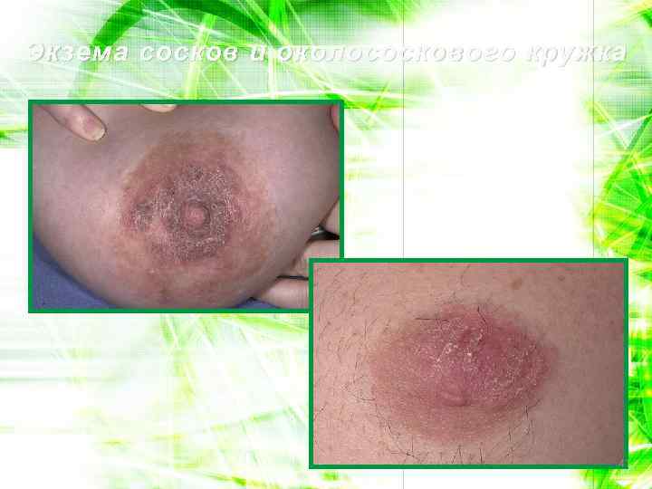 Экзема сосков и околососкового кружка 41 