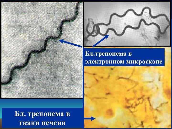 Бл. трепонема в электронном микроскопе Бл. трепонема в ткани печени 