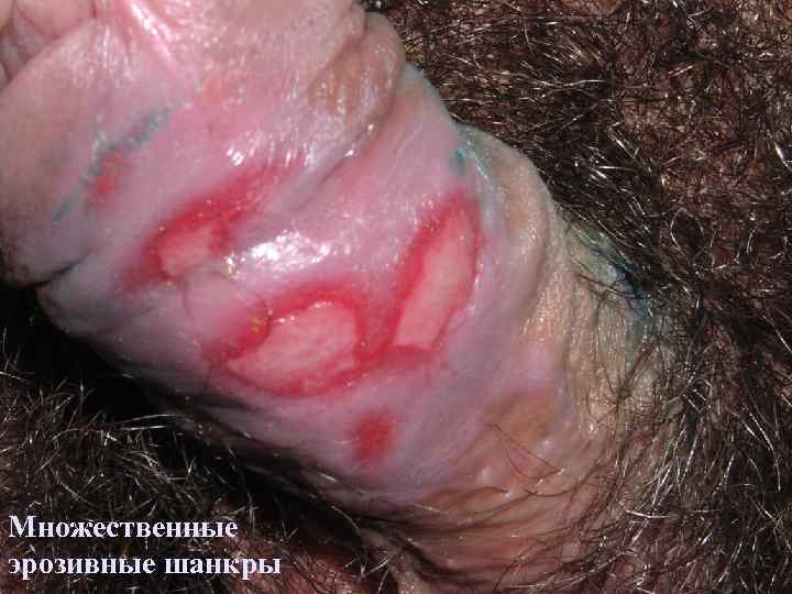 Множественные эрозивные шанкры 