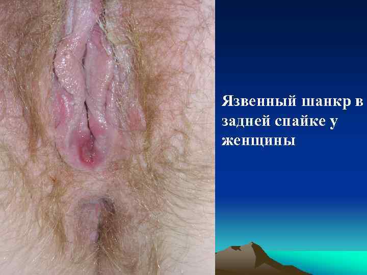 Язвенный шанкр в задней спайке у женщины 