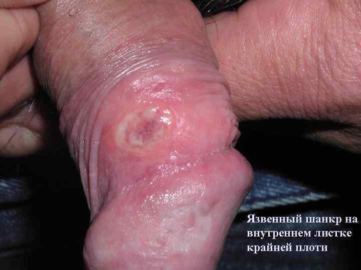 Язвенный шанкр на внутреннем листке крайней плоти 