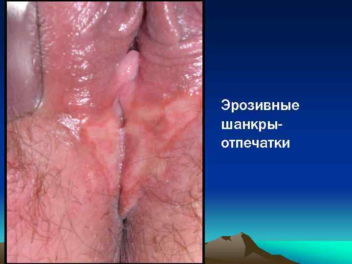 Эрозивные шанкрыотпечатки 