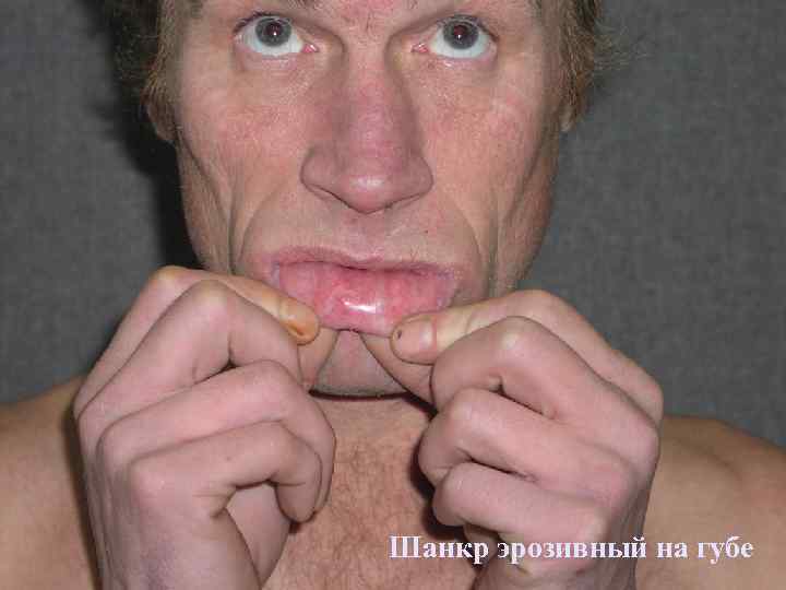 Шанкр эрозивный на губе 