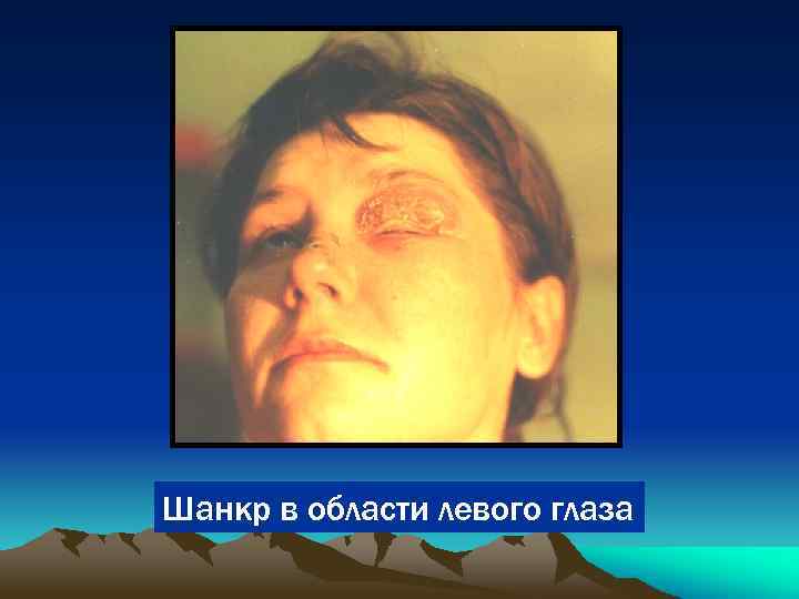 Шанкр в области левого глаза 