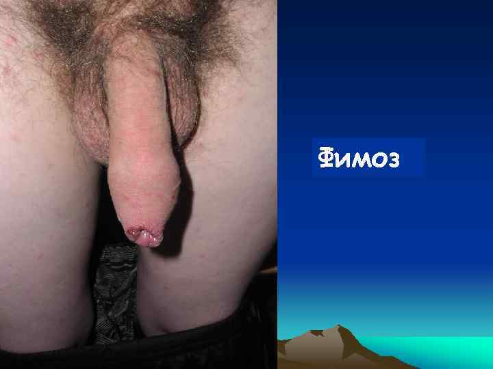 Фимоз 