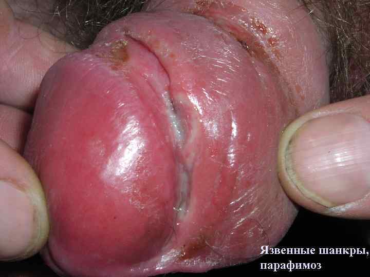 Язвенные шанкры, парафимоз 