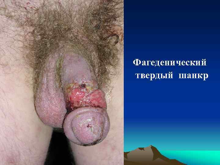 Фагеденический твердый шанкр 