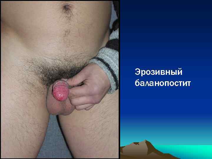 Эрозивный баланопостит 