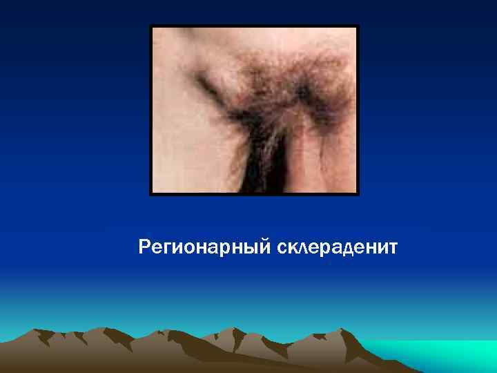 Регионарный склераденит 