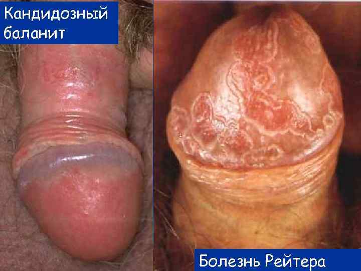 Кандидозный баланит Болезнь Рейтера 
