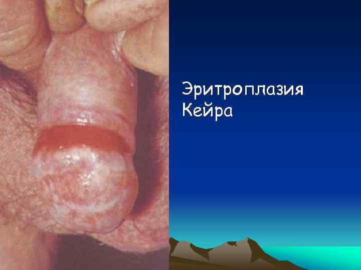 Эритроплазия Кейра 