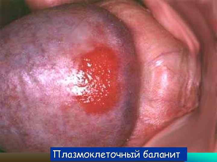 Плазмоклеточный баланит 