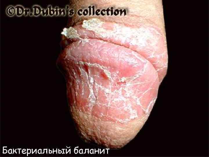 Бактериальный баланит 