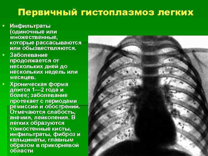 Гистоплазмоз клиническая картина