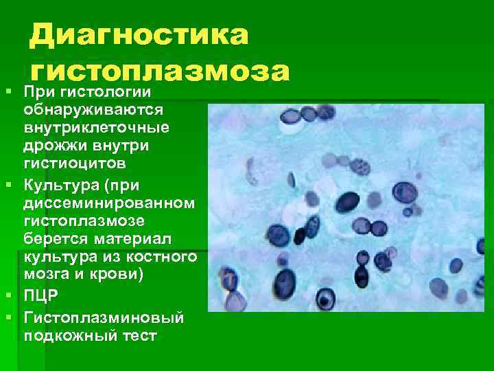 Гистоплазмоз клиническая картина