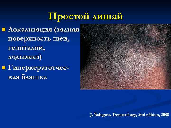 Простой лишай Локализация (задняя поверхность шеи, гениталии, лодыжки) n Гиперкератотческая бляшка n J. Bolognia.