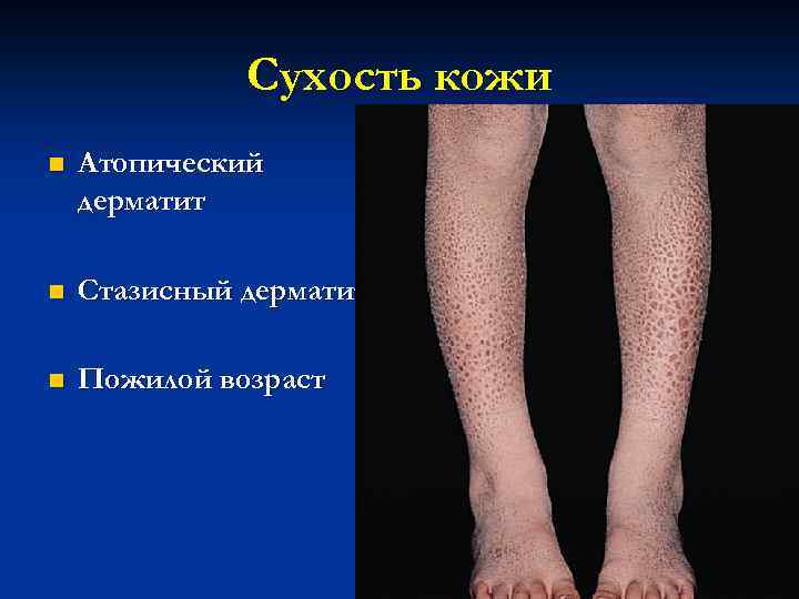 Сухость кожи n Атопический дерматит n Стазисный дерматит n Пожилой возраст 