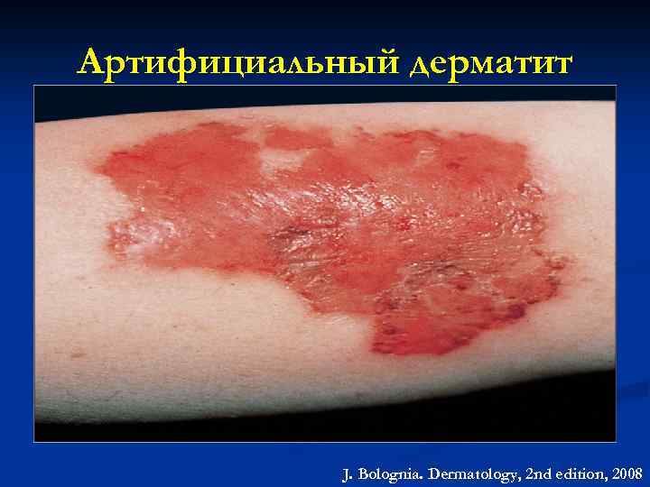 Артифициальный дерматит J. Bolognia. Dermatology, 2 nd edition, 2008 
