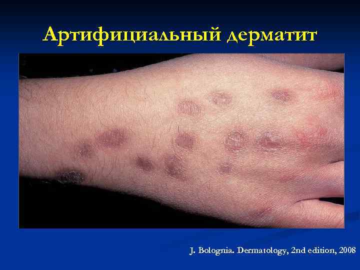 Артифициальный дерматит J. Bolognia. Dermatology, 2 nd edition, 2008 