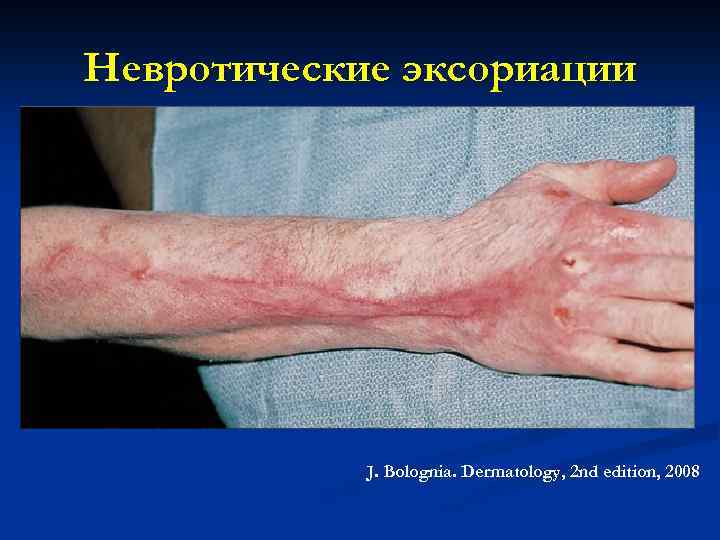 Невротические эксориации J. Bolognia. Dermatology, 2 nd edition, 2008 