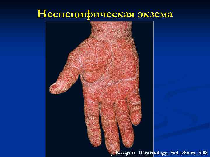 Неспецифическая экзема J. Bolognia. Dermatology, 2 nd edition, 2008 