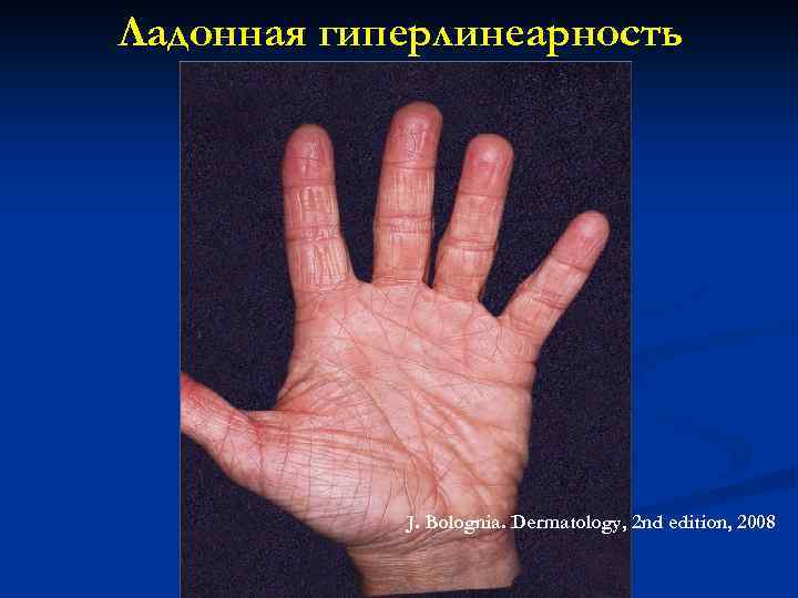 Ладонная гиперлинеарность J. Bolognia. Dermatology, 2 nd edition, 2008 