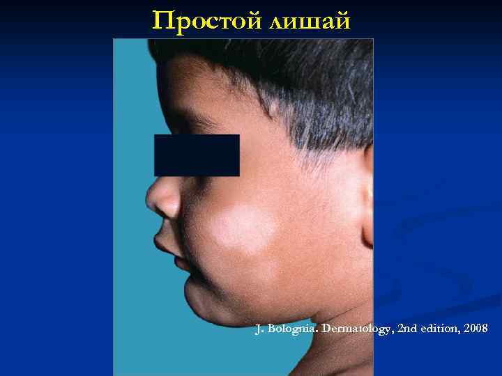 Простой лишай J. Bolognia. Dermatology, 2 nd edition, 2008 