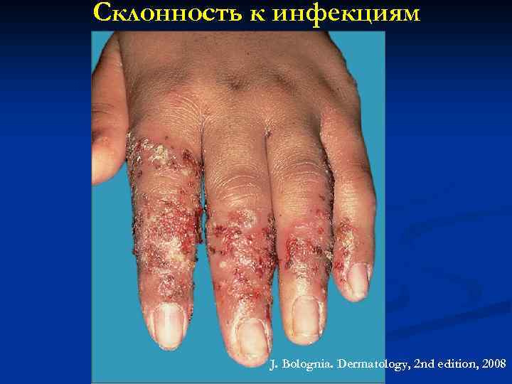Склонность к инфекциям J. Bolognia. Dermatology, 2 nd edition, 2008 