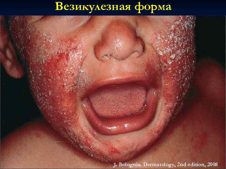 Везикулезная форма J. Bolognia. Dermatology, 2 nd edition, 2008 
